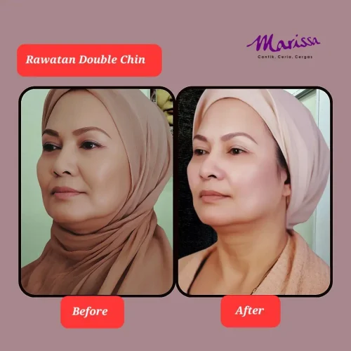 rl-doublechin-ba1