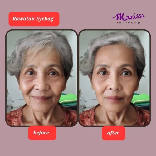 rl-eyebag-ba1