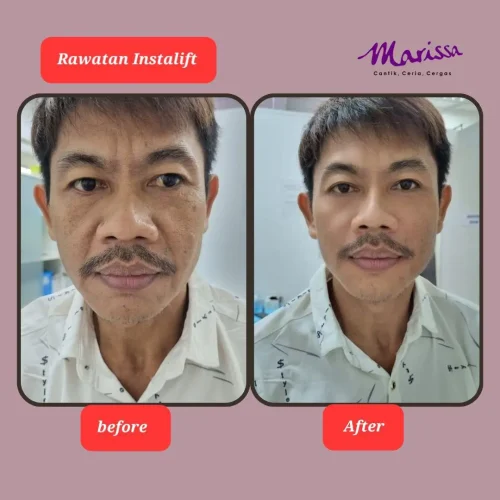 rl-instalift-ba2