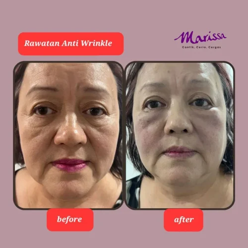 rl-wrinkle-b2