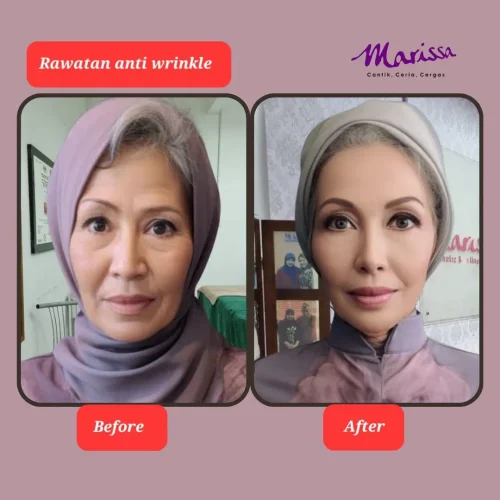 rl-wrinkle-ba1